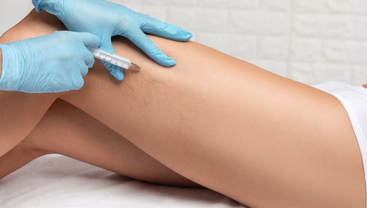 Spider Vein Treatment - leg with spider veins receiving an injection