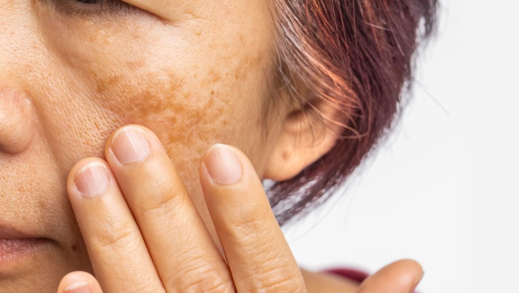 Pigmentation & Skin Tone
