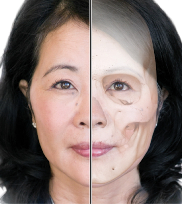 Facial aging treatment